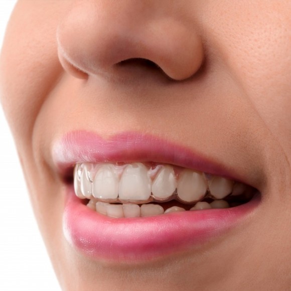 Invisalign Treatments For Straighter Teeth